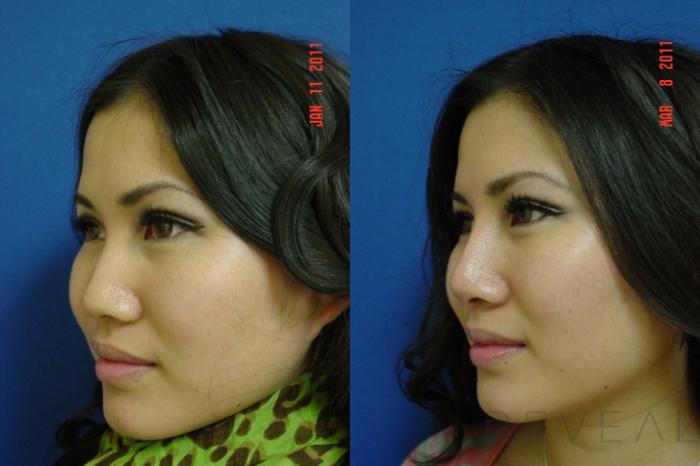 Before & After Asian Rhinoplasty Case 55 View #4 View in San Jose, CA