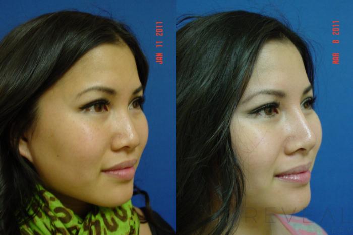 Before & After Asian Rhinoplasty Case 55 View #5 View in San Jose, CA