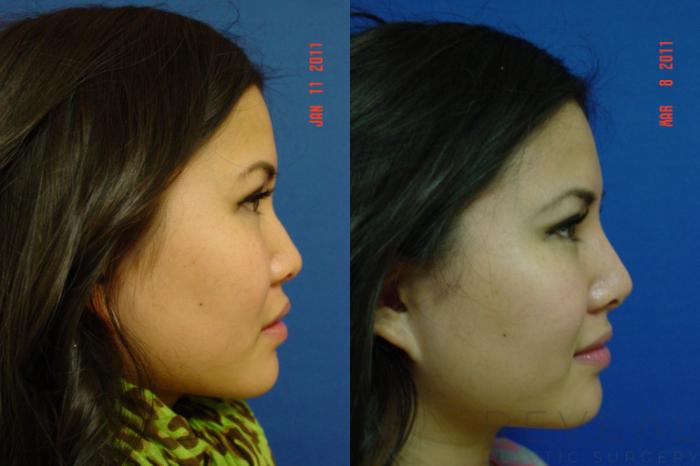 Before & After Asian Rhinoplasty Case 55 View #6 View in San Jose, CA