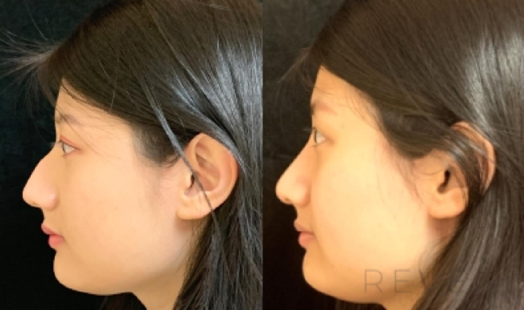 Before & After Rhinoplasty Case 560 View #1 View in San Jose, CA