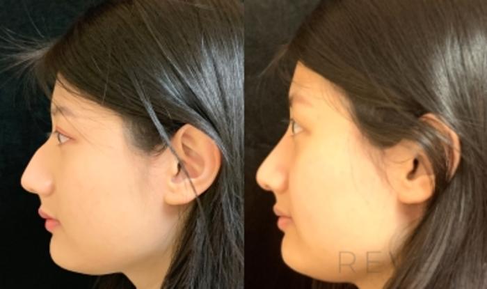 Before & After Asian Rhinoplasty Case 560 View #1 View in San Jose, CA