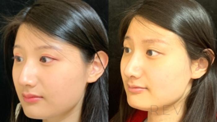 Before & After Asian Rhinoplasty Case 560 View #2 View in San Jose, CA