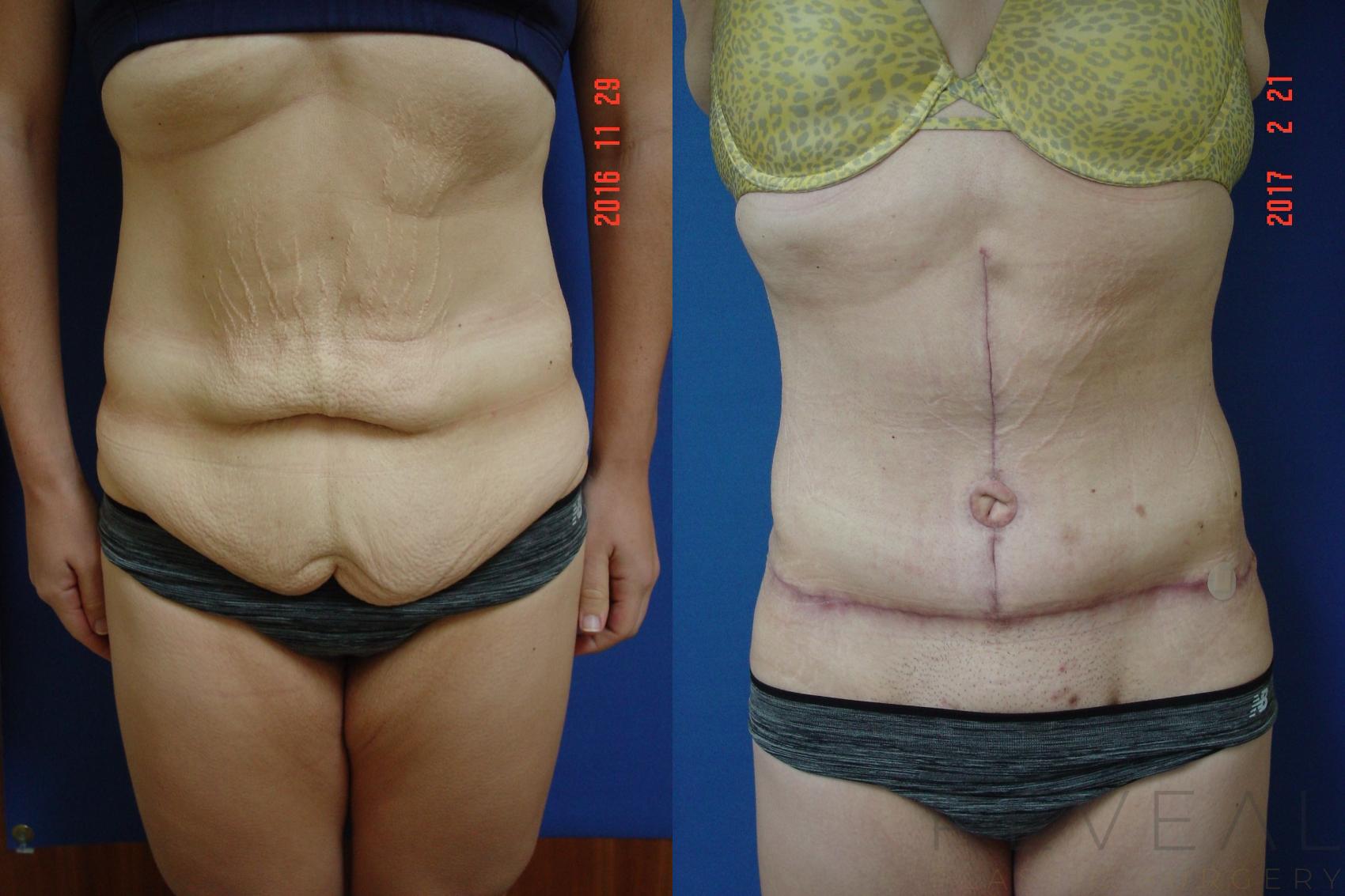 Before & After Tummy Tuck Case 208 View #1 View in San Jose, CA