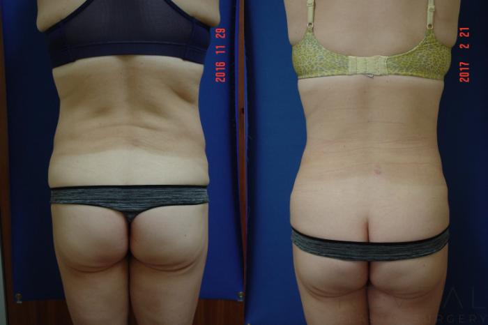 Before & After Body Lift Case 208 View #2 View in San Jose, CA