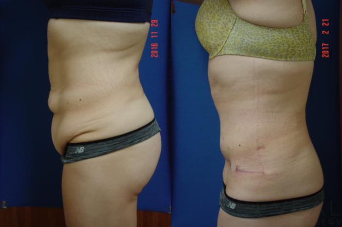 Before & After Tummy Tuck Case 208 View #3 View in San Jose, CA