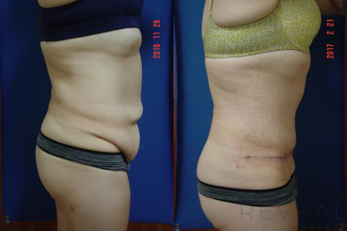 Before & After Tummy Tuck Case 208 View #4 View in San Jose, CA