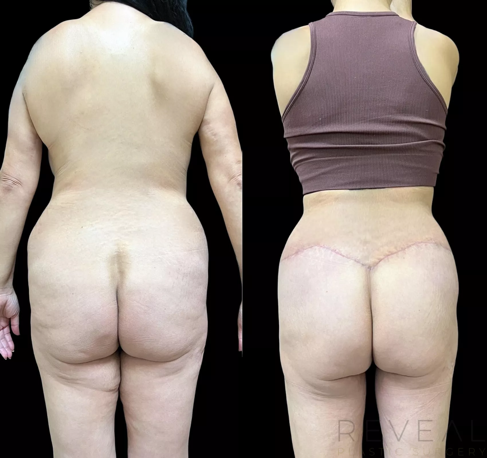 https://images.revealplasticsurgery.com/content/images/body-lift-694-back-detail.webp