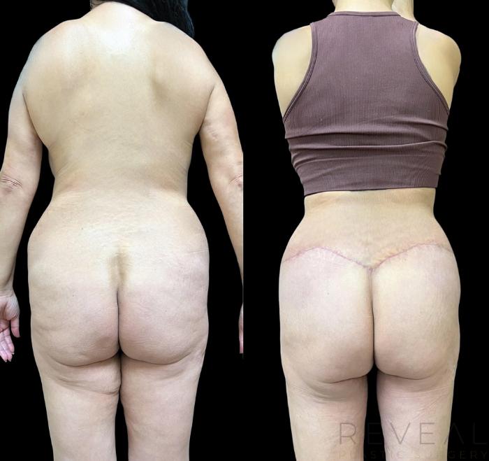 Before & After Thigh Lift Case 694 Back View in San Jose, CA