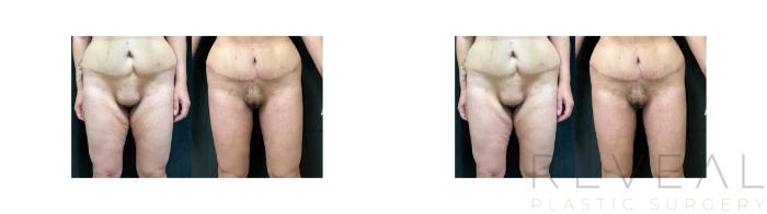 Before & After Thigh Lift Case 694 Front View in San Jose, CA