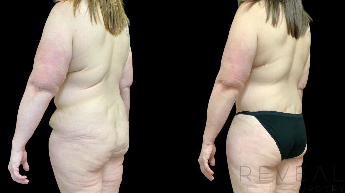 Before & After Body Lift Case 771 Left Back Oblique View in San Jose, CA