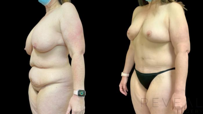 Before & After Body Lift Case 771 Left Oblique View in San Jose, CA