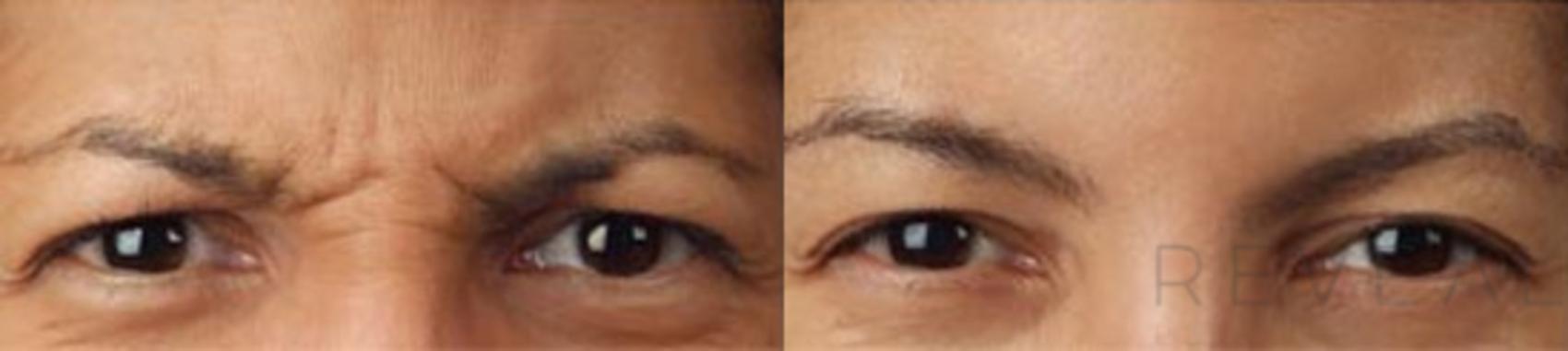 Before & After BOTOX® Cosmetic Case 11 View #1 View in San Jose, CA