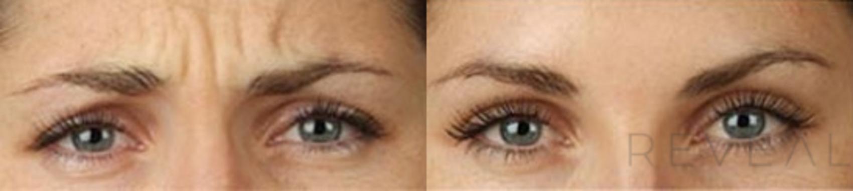 Before & After BOTOX® Cosmetic Case 12 View #1 View in San Jose, CA