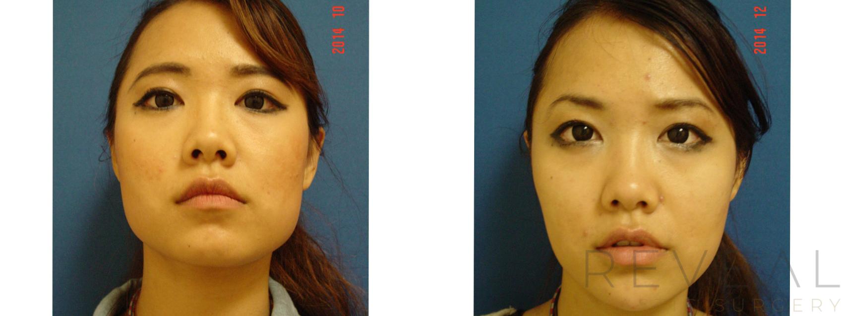 Before & After BOTOX® Cosmetic Case 163 View #1 View in San Jose, CA
