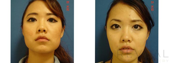 Before & After Injectable Fillers Case 163 View #1 View in San Jose, CA