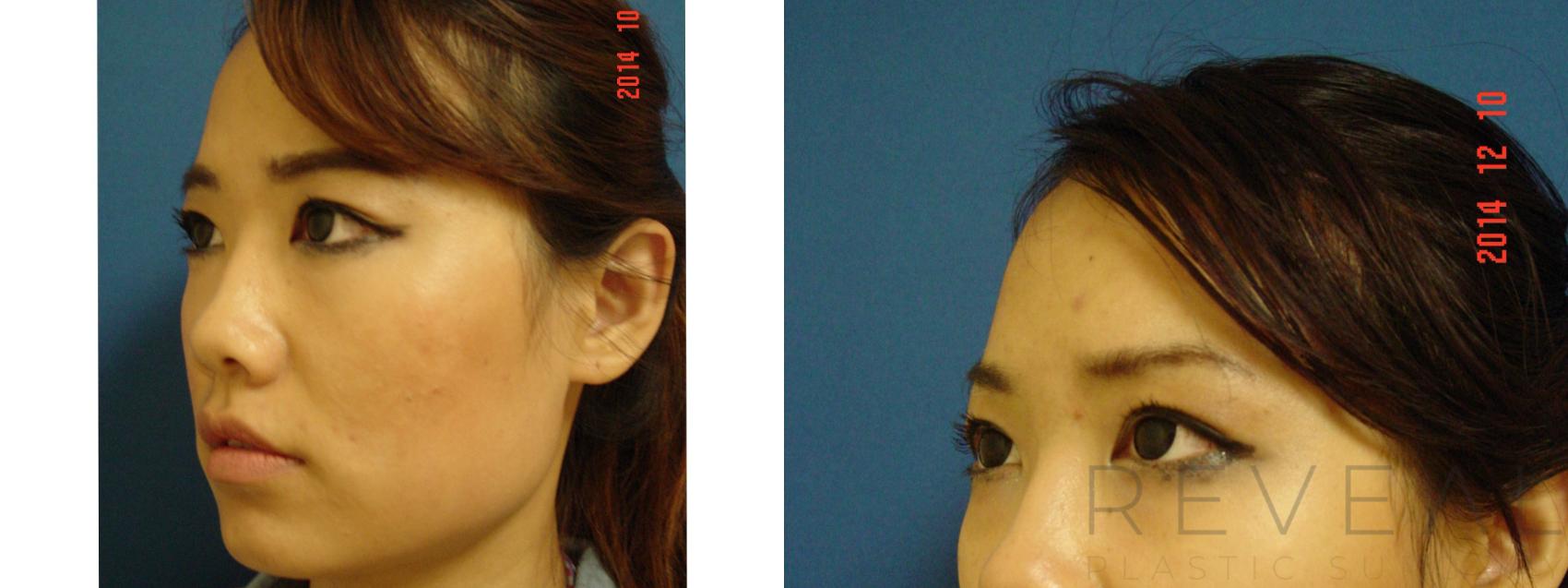 Before & After BOTOX® Cosmetic Case 163 View #2 View in San Jose, CA