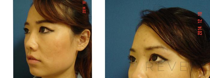Before & After Injectable Fillers Case 163 View #2 View in San Jose, CA