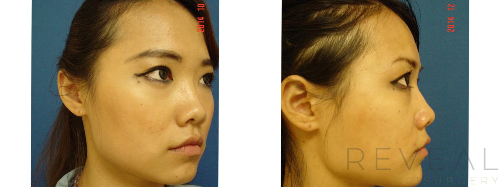 Before & After BOTOX® Cosmetic Case 163 View #3 View in San Jose, CA