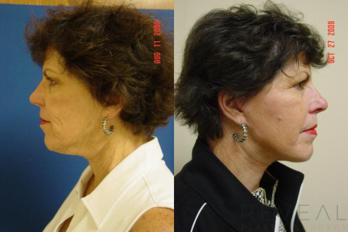 Before & After BOTOX® Cosmetic Case 19 View #2 View in San Jose, CA
