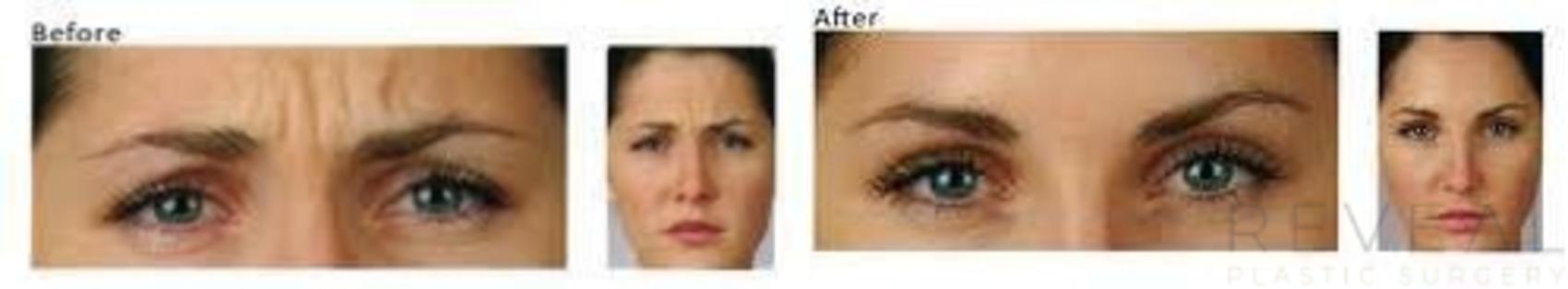 Before & After BOTOX® Cosmetic Case 24 View #1 View in San Jose, CA
