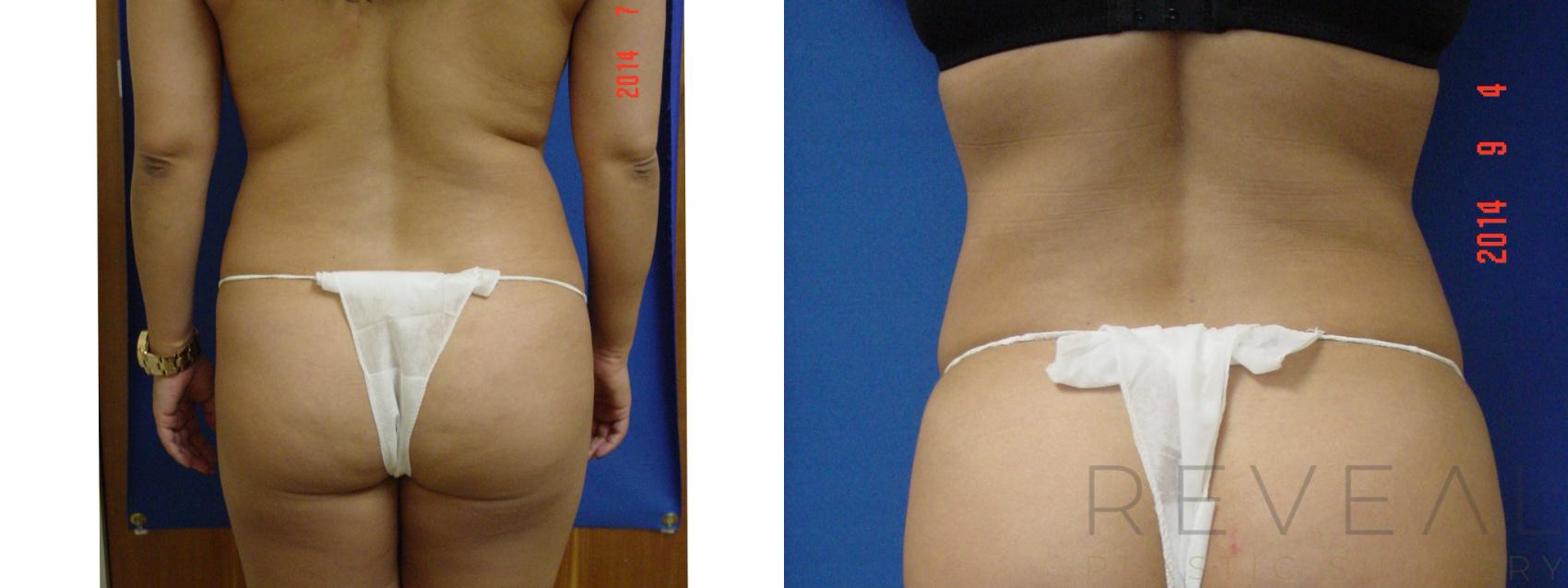 Before & After Liposuction Case 155 View #1 View in San Jose, CA