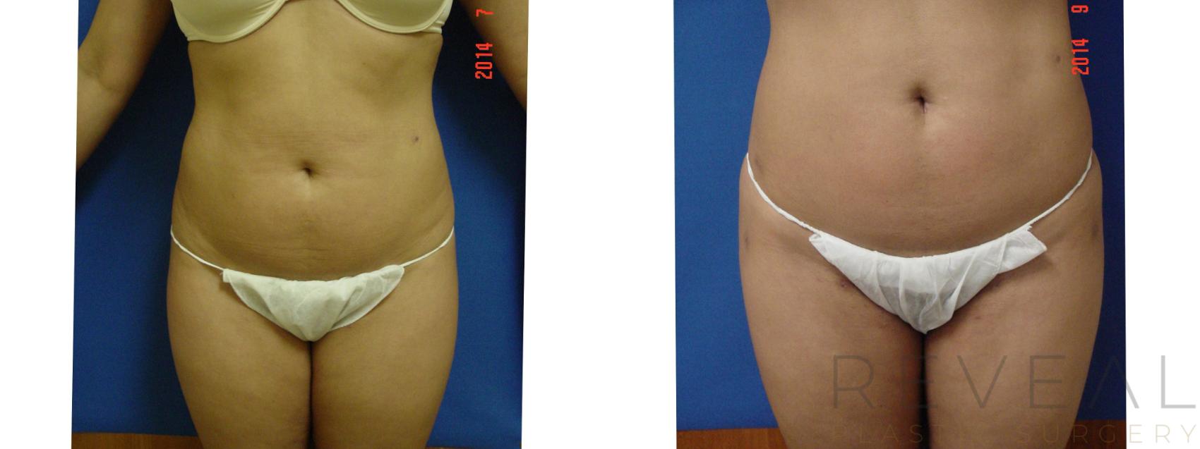 Before & After Liposuction Case 155 View #2 View in San Jose, CA