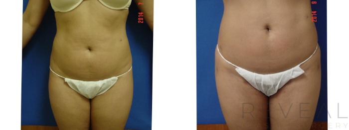 Before & After Brazilian Butt Lift Case 155 View #2 View in San Jose, CA