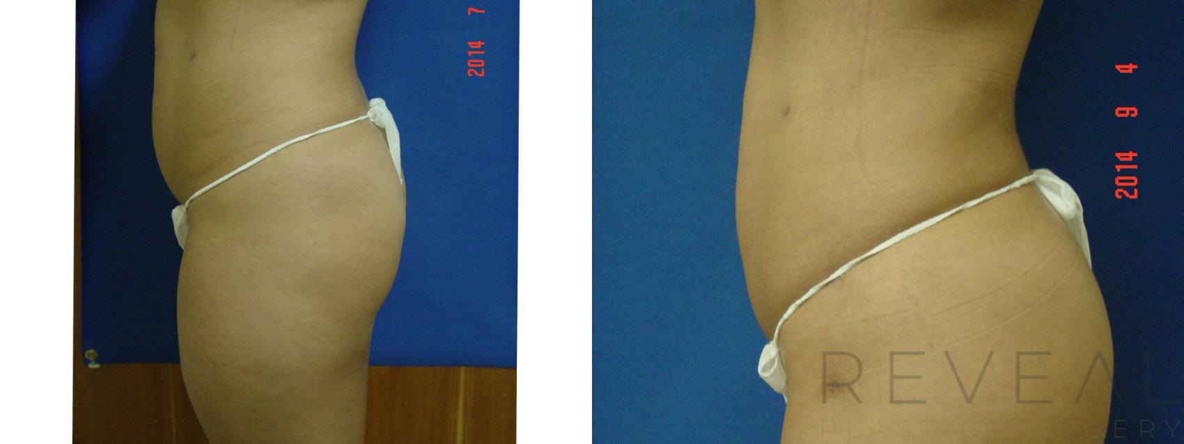 Before & After Liposuction Case 155 View #4 View in San Jose, CA