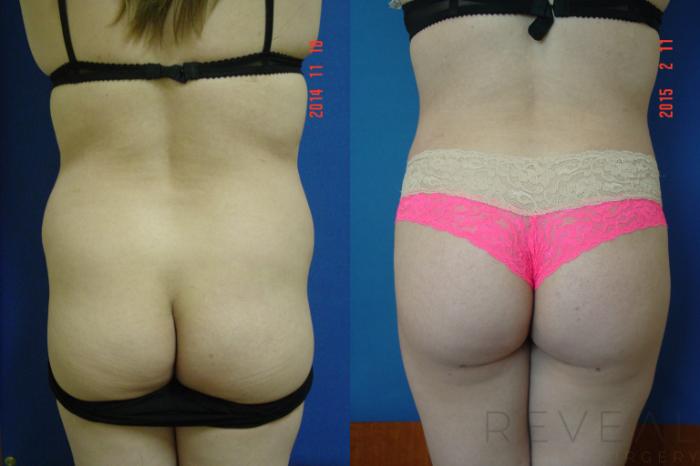 Before & After Liposuction Case 170 View #1 View in San Jose, CA