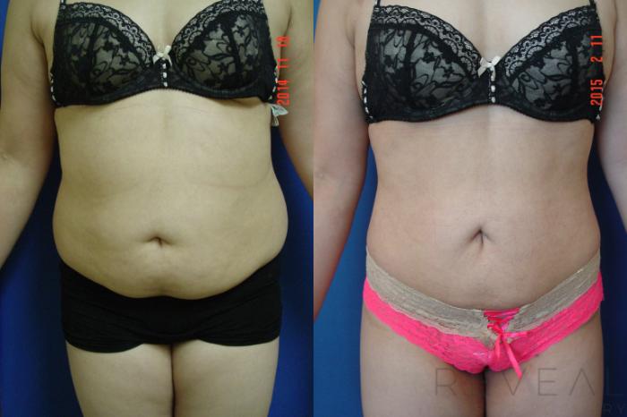 Before & After Brazilian Butt Lift Case 170 View #2 View in San Jose, CA