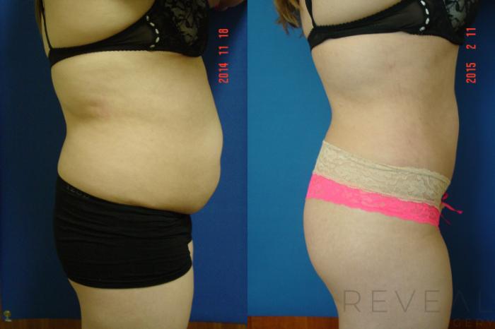 Before & After Liposuction Case 170 View #3 View in San Jose, CA