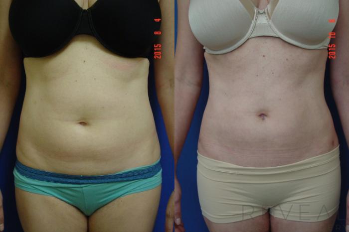 Before & After Liposuction Case 181 View #2 View in San Jose, CA