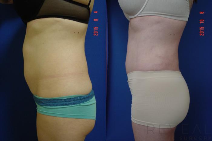 Before & After Brazilian Butt Lift Case 181 View #3 View in San Jose, CA