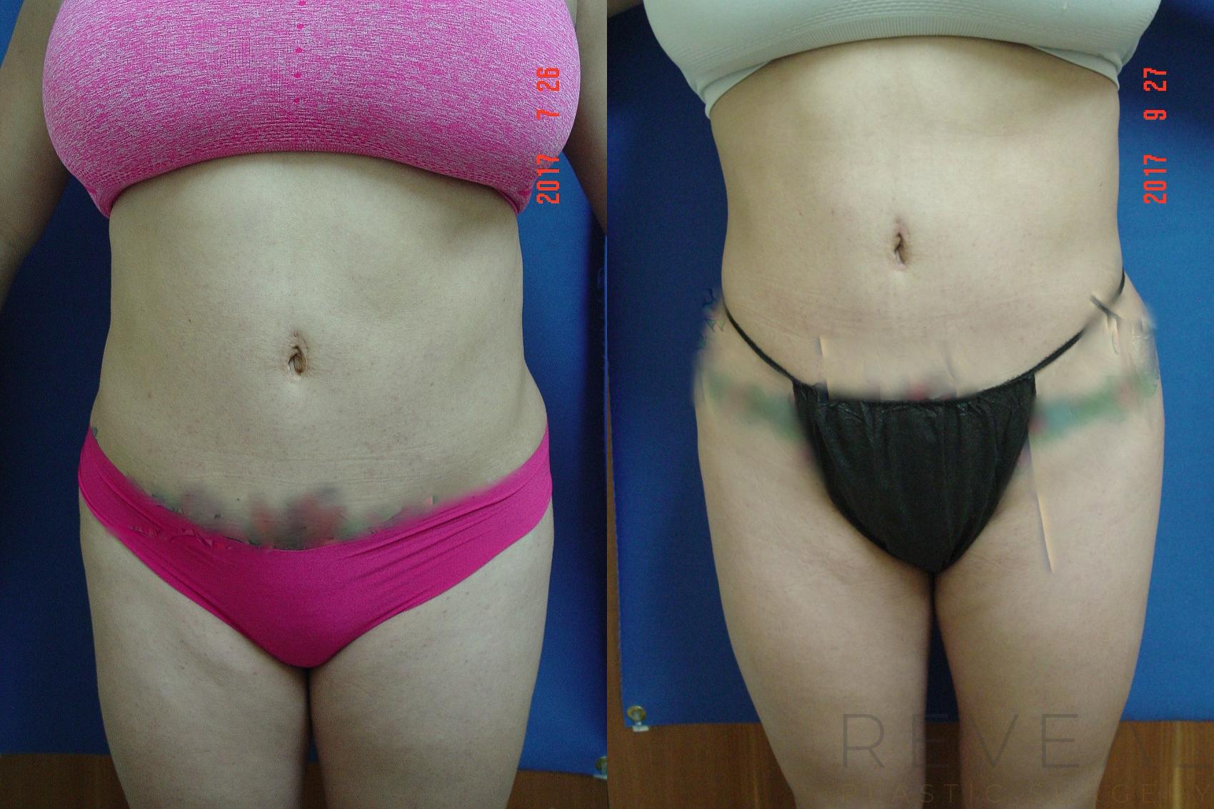 Before & After Brazilian Butt Lift Case 225 View #1 View in San Jose, CA