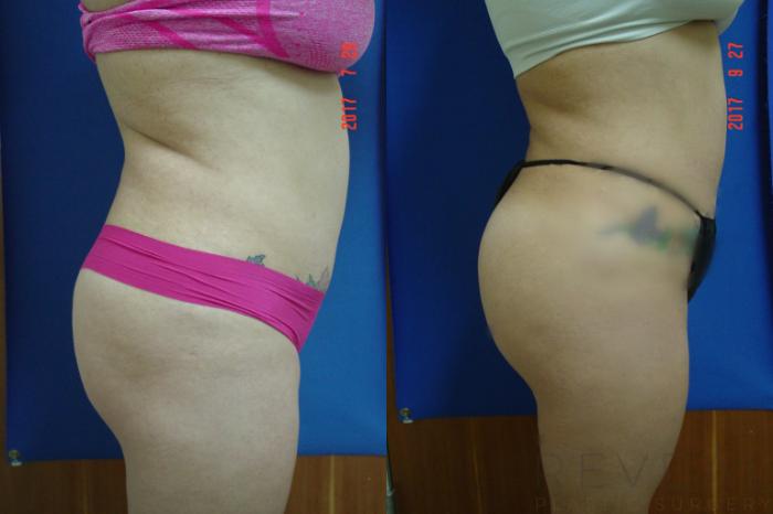 Before & After Brazilian Butt Lift Case 225 View #3 View in San Jose, CA