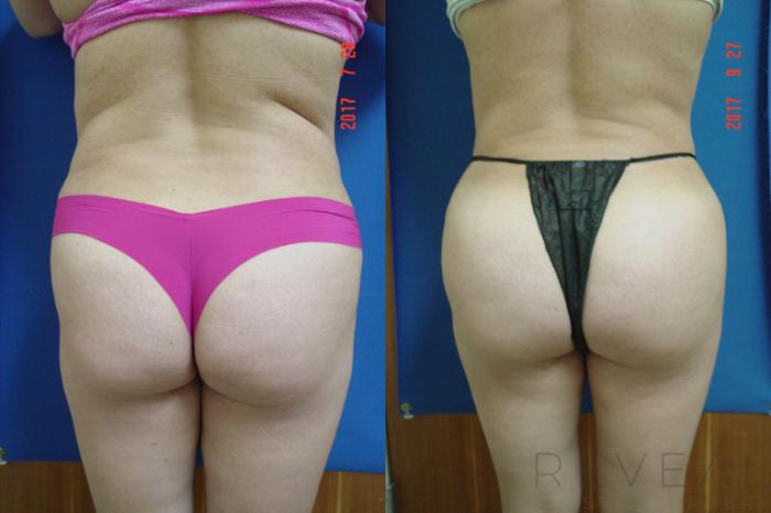 Before & After Liposuction Case 225 View #4 View in San Jose, CA