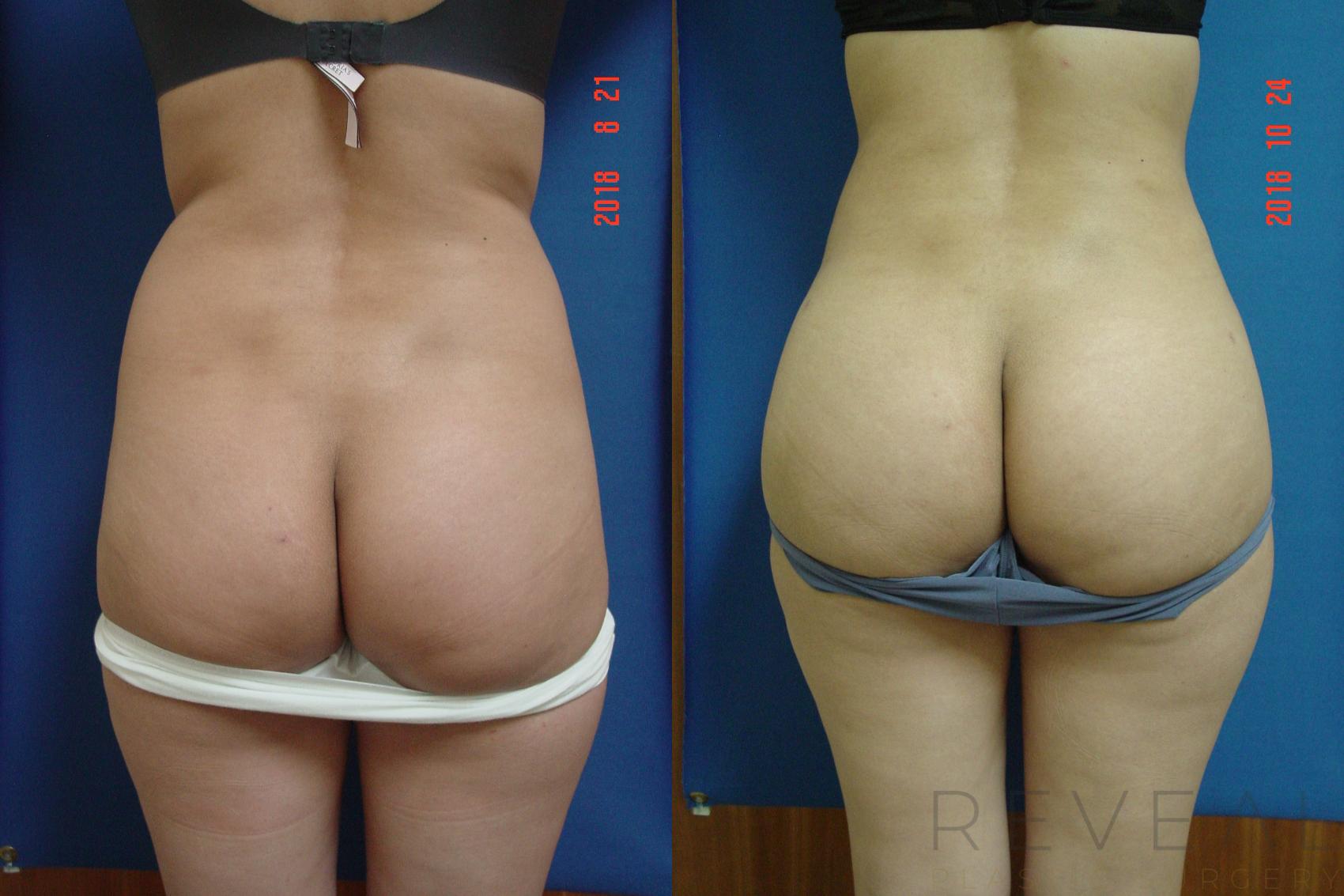 Before & After Brazilian Butt Lift Case 266 View #1 View in San Jose, CA