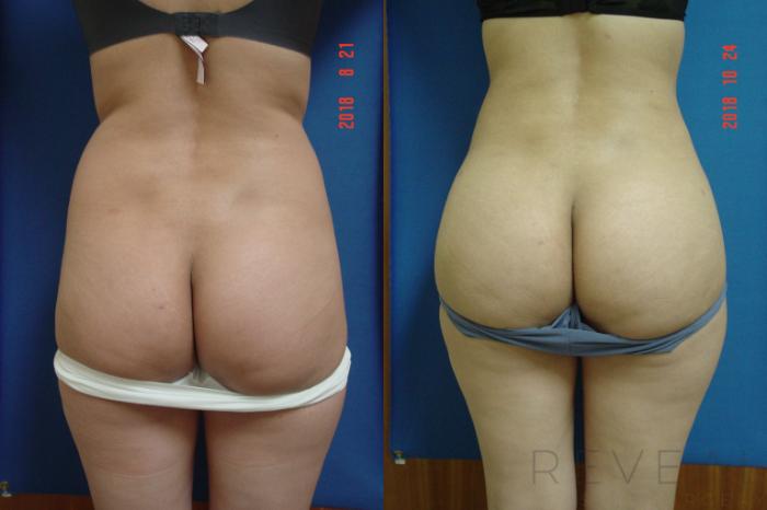 Before & After Liposuction Case 266 View #1 View in San Jose, CA