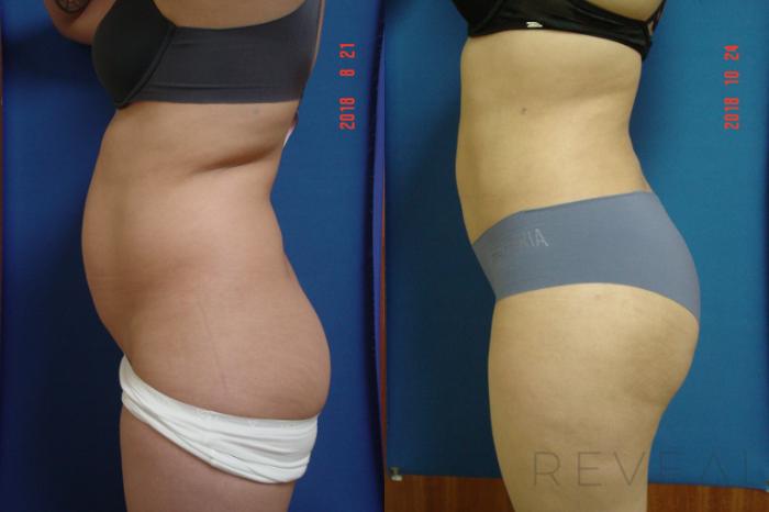 Before & After Liposuction Case 266 View #2 View in San Jose, CA