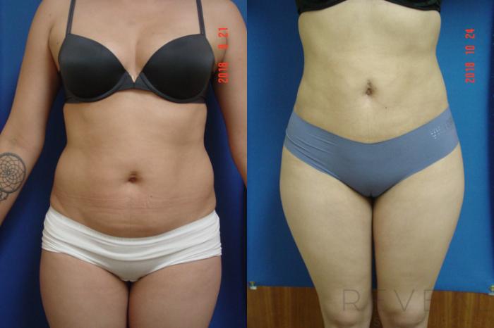Before & After Liposuction Case 266 View #3 View in San Jose, CA