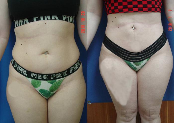 Before & After Liposuction Case 316 View #1 View in San Jose, CA