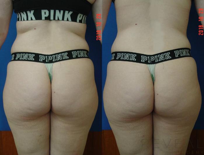 Before & After Brazilian Butt Lift Case 316 View #3 View in San Jose, CA