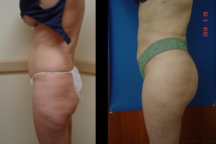 Before & After Liposuction Case 339 View #1 View in San Jose, CA