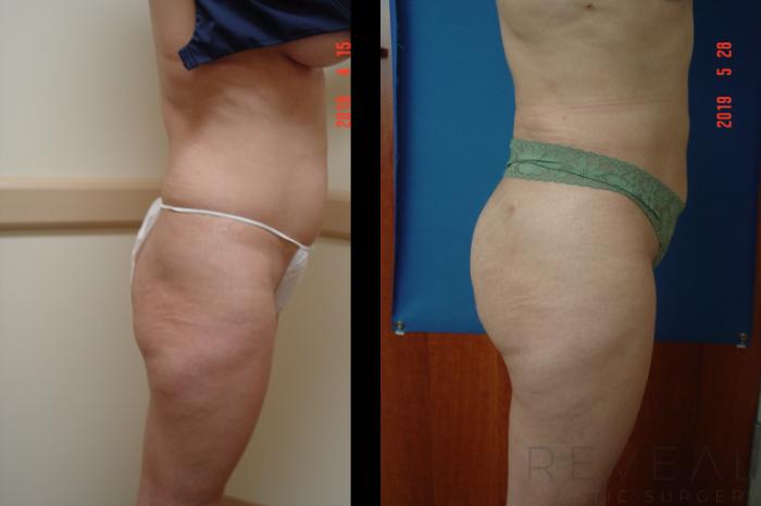 Before & After Brazilian Butt Lift Case 339 View #2 View in San Jose, CA