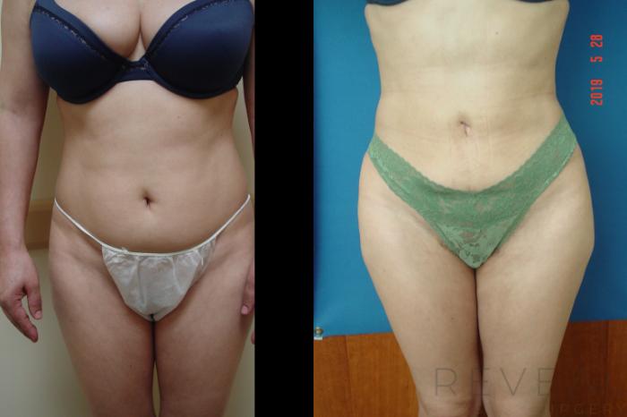 Before & After Liposuction Case 339 View #3 View in San Jose, CA