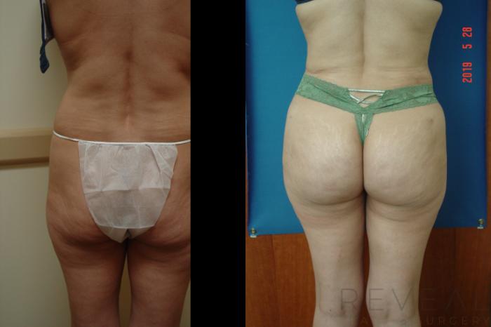 Before & After Liposuction Case 339 View #4 View in San Jose, CA