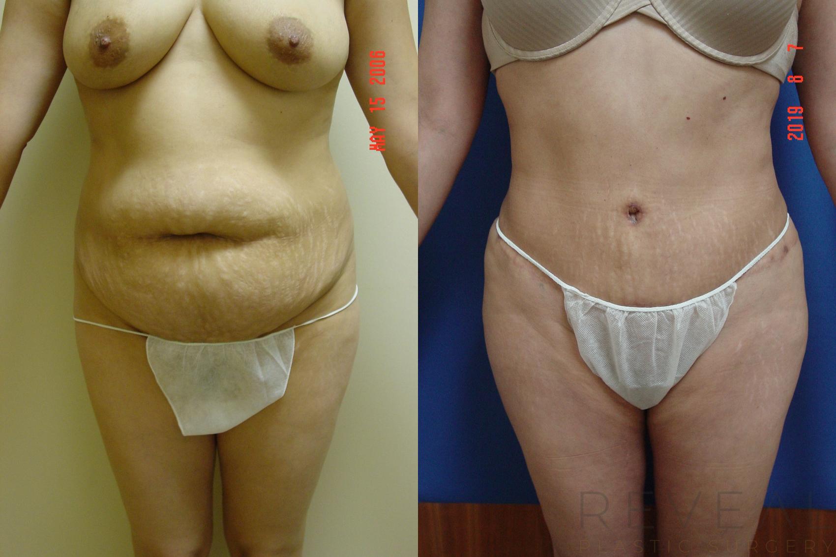 Before & After Tummy Tuck Case 358 View #1 View in San Jose, CA
