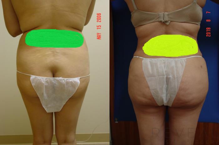 Before & After Brazilian Butt Lift Case 358 View #2 View in San Jose, CA