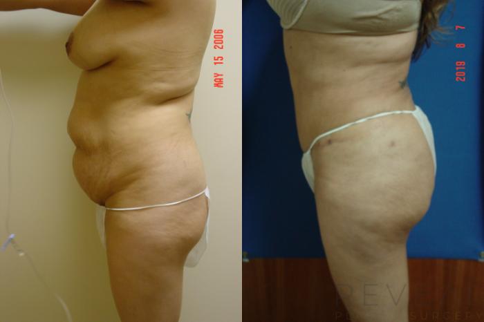Before & After Brazilian Butt Lift Case 358 View #3 View in San Jose, CA