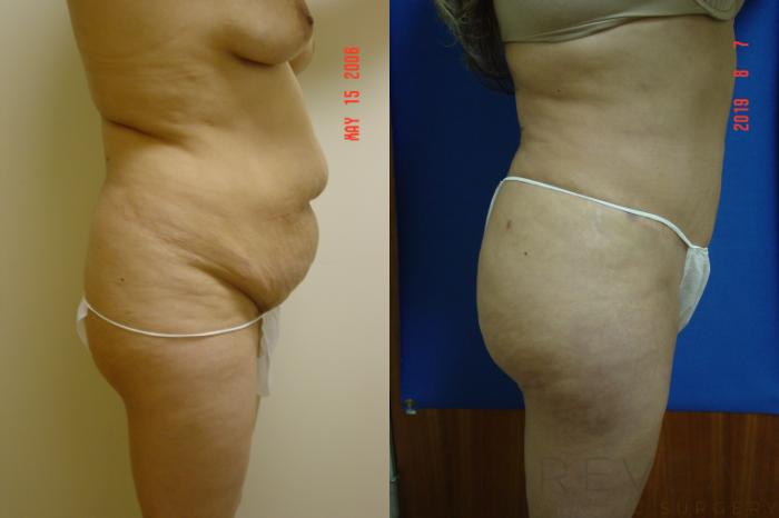 Before & After Tummy Tuck Case 358 View #4 View in San Jose, CA